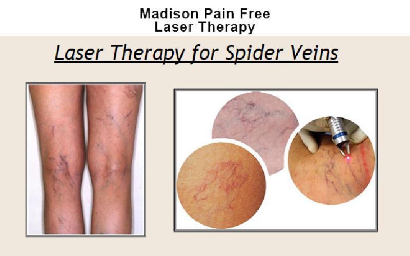 Madison Laser Therapy - $125 Gift Certificate for Spider Vein Therapy for $65 at Madison Laser Therapy