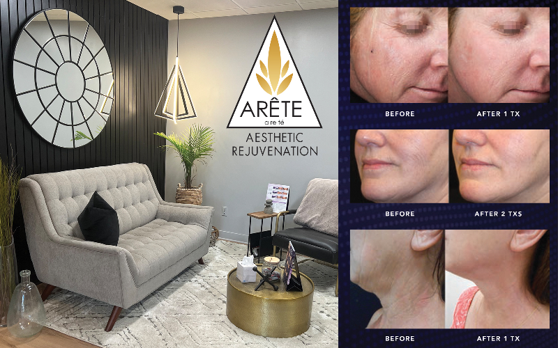 Arete Aesthetic Rejuvination - Opus Plasma Skin Resurfacing